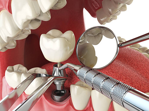 Best Emergency Dental Care for Broken or Chipped Teeth in Holland, OH